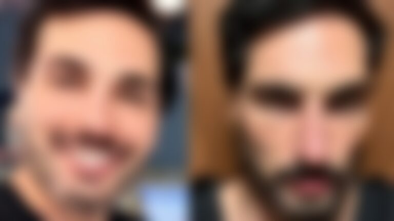 Influencer famoso viraliza ao sugir com o rosto ‘derretido’ após o uso de caneta emagrecedora