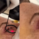 Famosa retira tumores abaixo dos olhos e desabafa: ‘Medo’