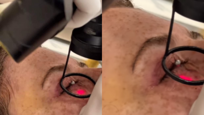 Famosa retira tumores abaixo dos olhos e desabafa: 'Medo'