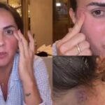 Esposa de Zezé Di Camargo, Graciele Lacerda revela procedimento da filha por causa de nódulos: ‘Chorar’
