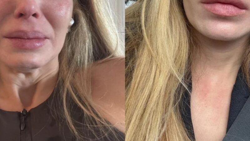 Atriz relata sofrimento com alopecia (Reprodução/Instagram)