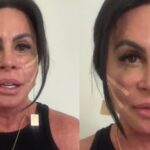 Gretchen surpreende ao retirar PMMA e revela tratamento que a fez desistir de cirurgia no rosto