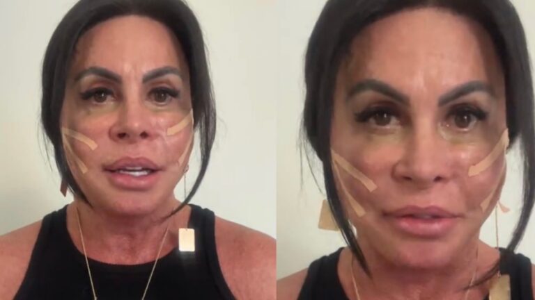 Gretchen surpreende ao retirar PMMA e revela tratamento que a fez desistir de cirurgia no rosto