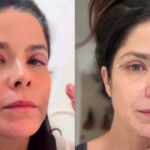 Cirurgia de Samara Felippo expõe condição silenciosa que pode afetar a visão
