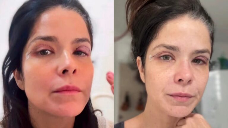 Cirurgia de Samara Felippo expõe condição silenciosa que pode afetar a visão