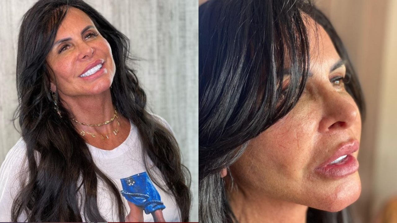 Gretchen faz novo procedimento facial e mostra resultados: “Olha isso!”