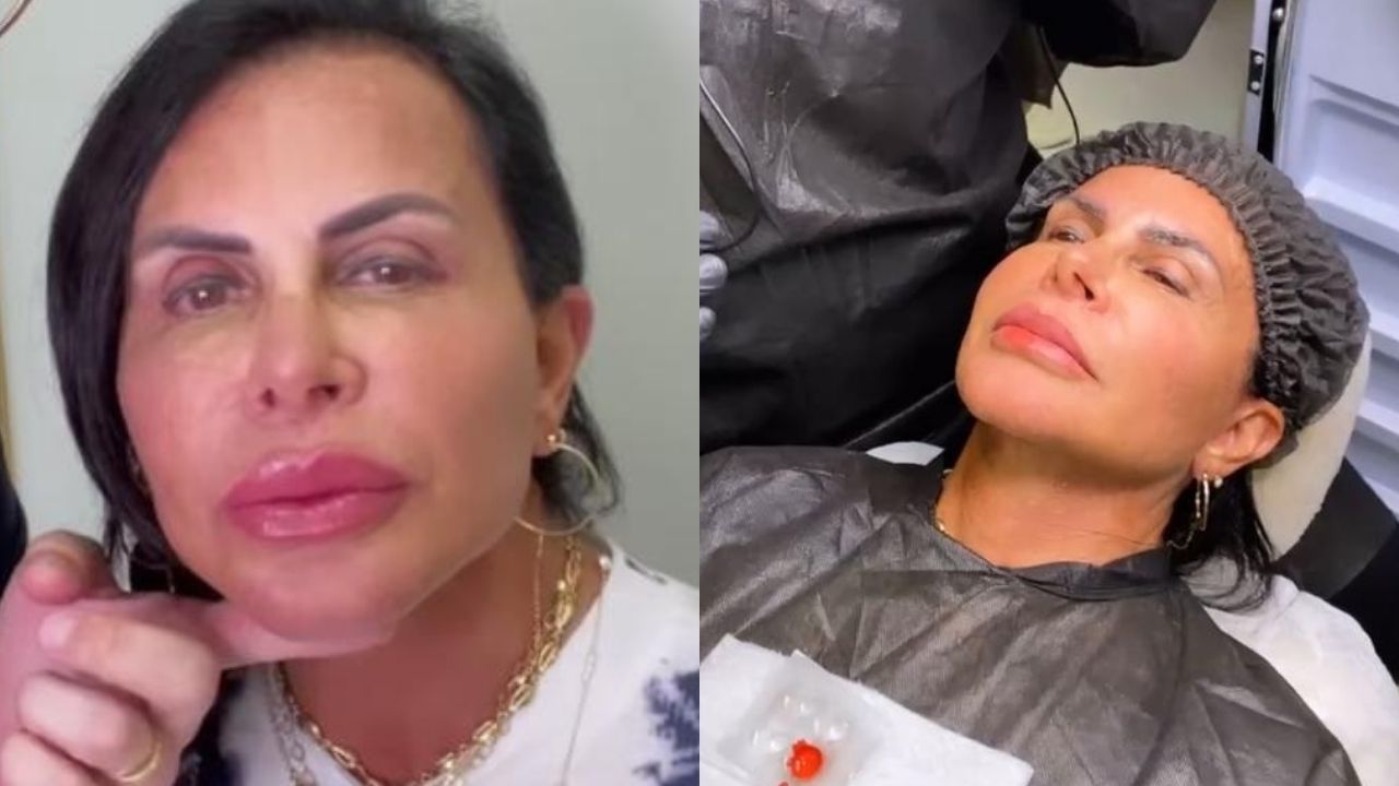 Transformação! Gretchen realiza novos procedimentos estéticos no rosto e exibe antes e depois