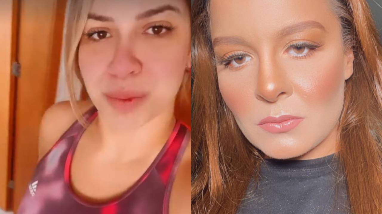 Agressão? Marilia Mendonça mostra hematoma após levar beliscão de Maiara: “Estão vendo esse roxo?”