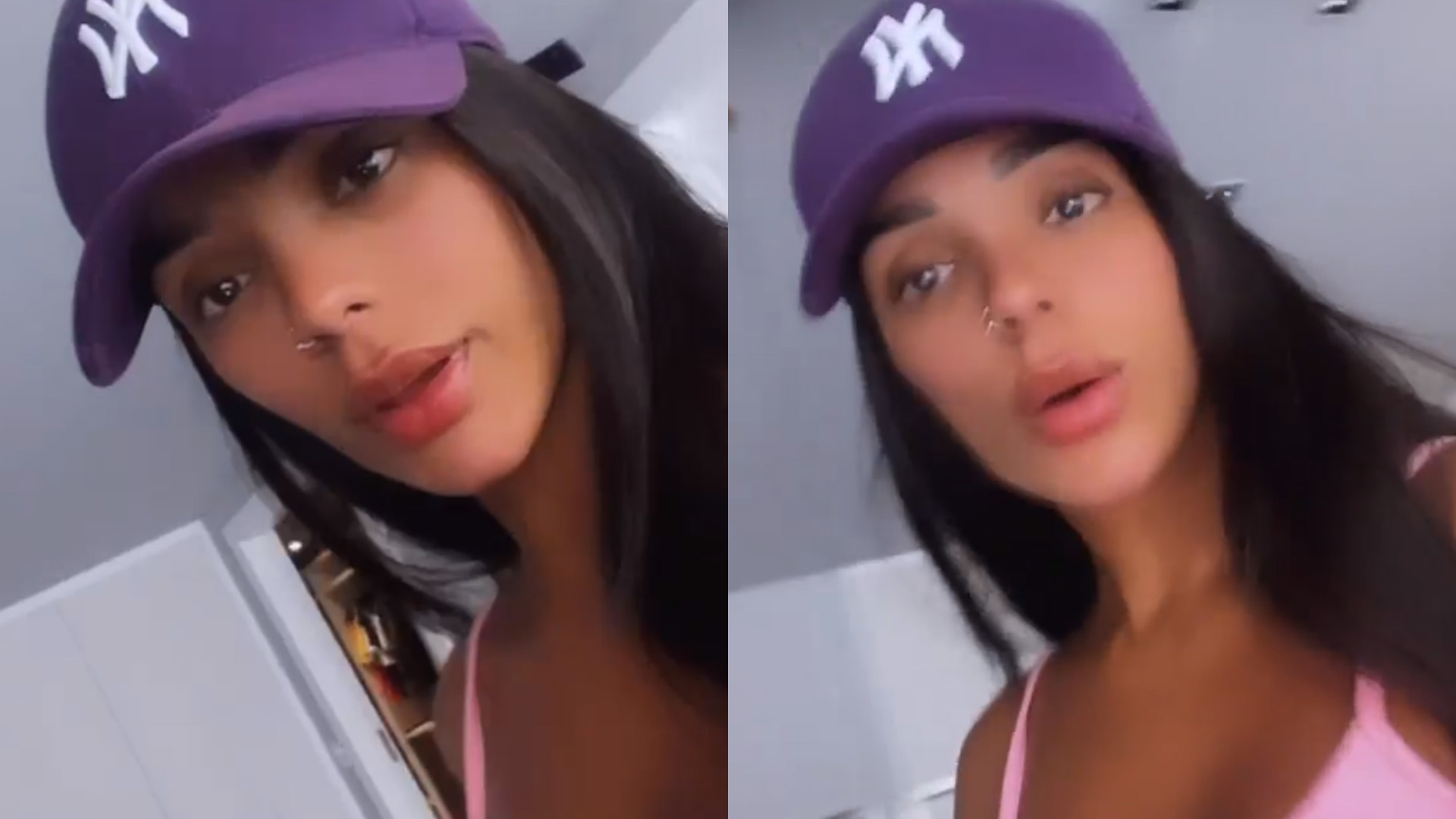 Ex-BBB Brunna Gonçalves mostra antes e depois de procedimento estético