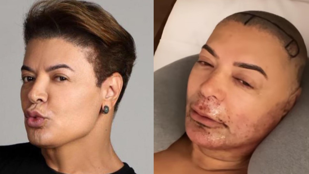 Aos 52 anos, David Brazil se submete a cirurgia plástica e mostra detalhes: “Estou me sentindo a Gretchen”