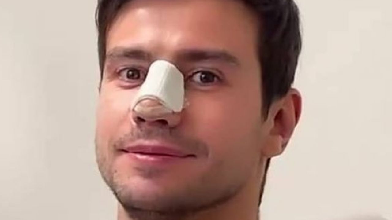 Mariano mostra antes e depois de cirurgia no nariz e surpreende fãs: “Sem palavras”