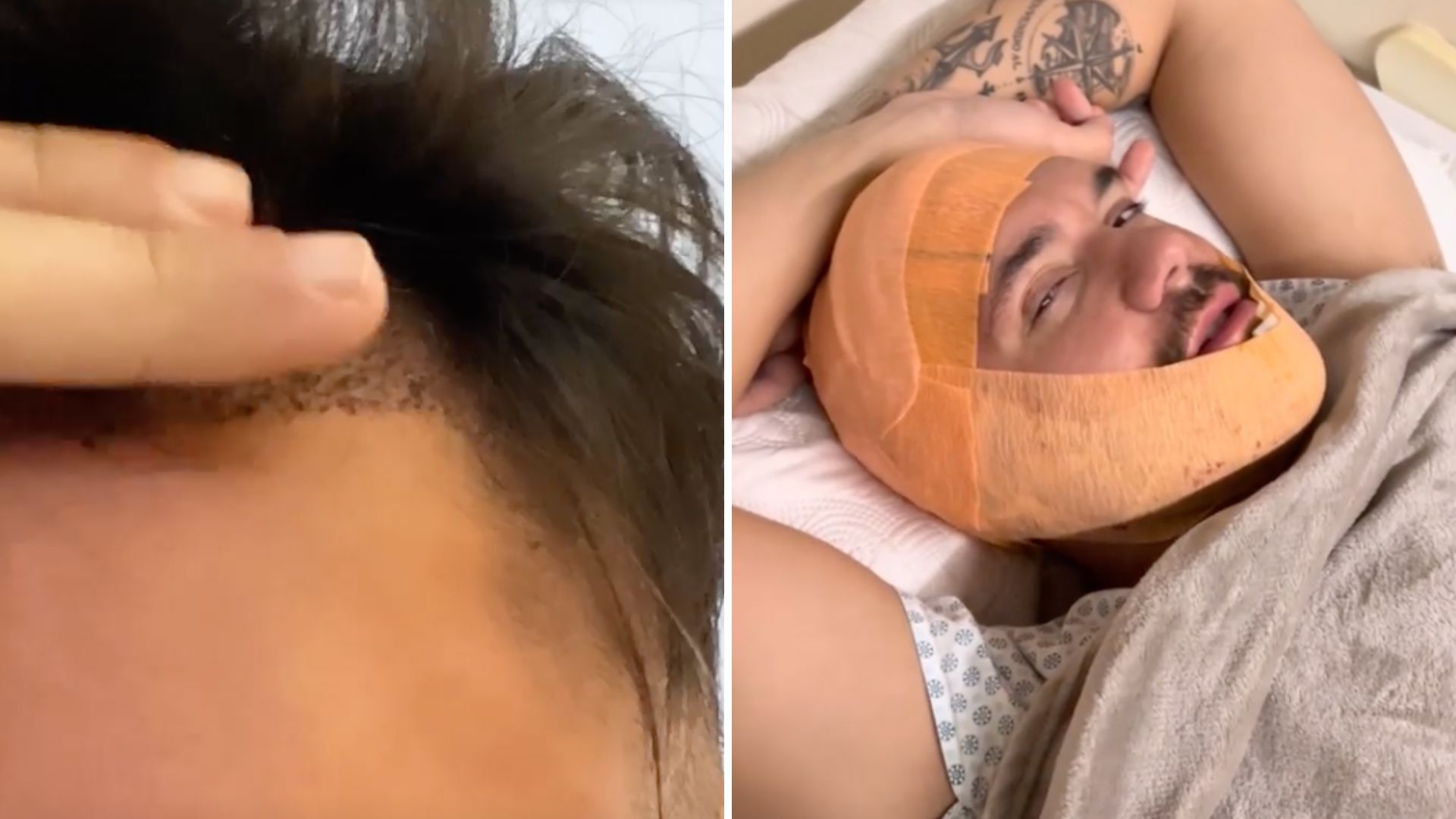 Irreconhecível, ex-BBB Eliezer mostra resultado do transplante de barba: “Me sentindo”