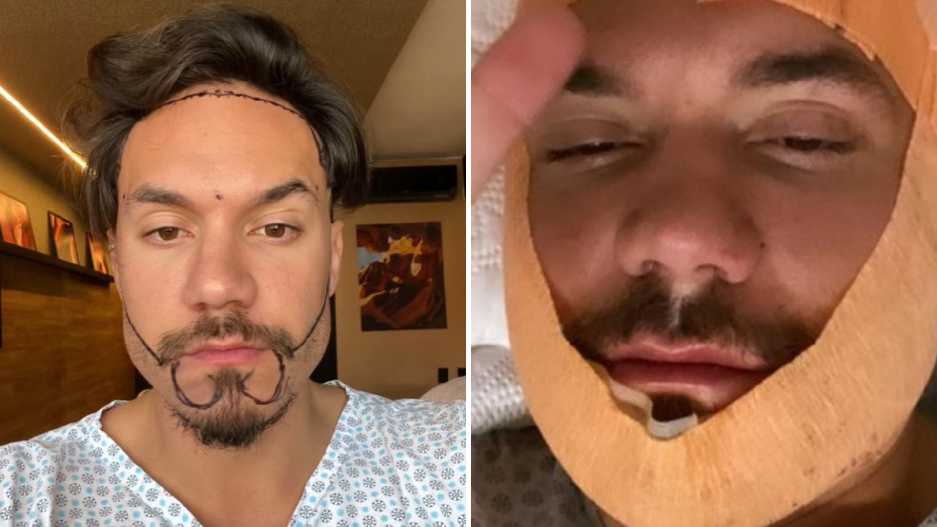 Ex-BBB Eliezer deixa valor astronômico em clínica de estética para mudar aparência; veja quanto