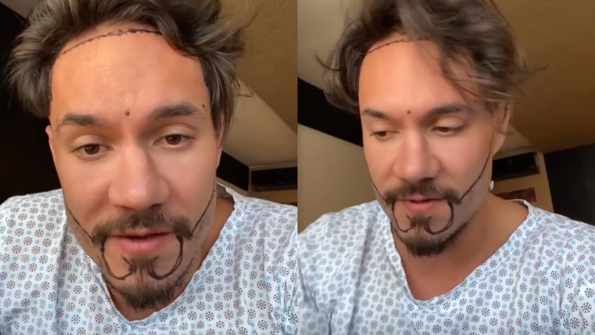 Ex-BBB Eliezer choca fãs ao expor processo de transplante capilar: “Sempre quis”
