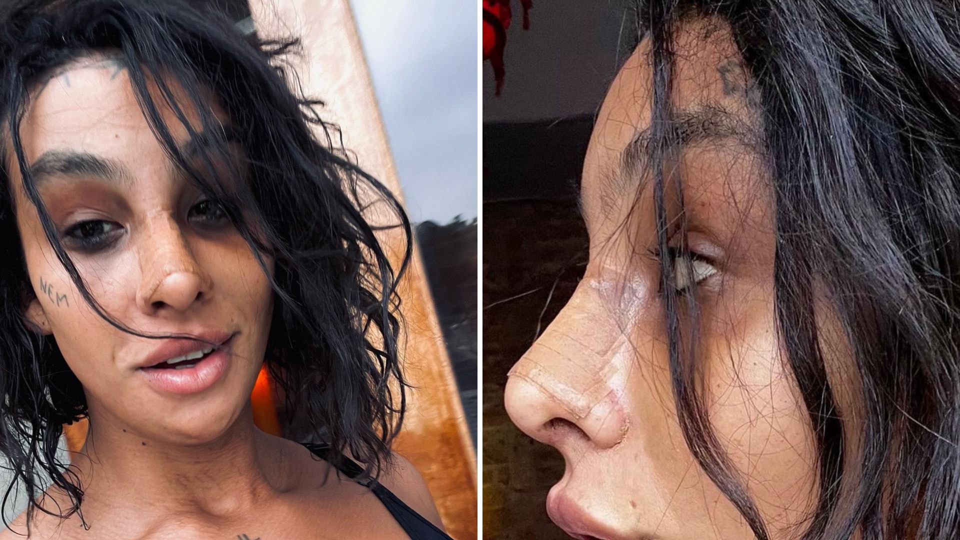 Linn da Quebrada mostra resultado de cirurgia de feminilização: “Biologicamente travesti”