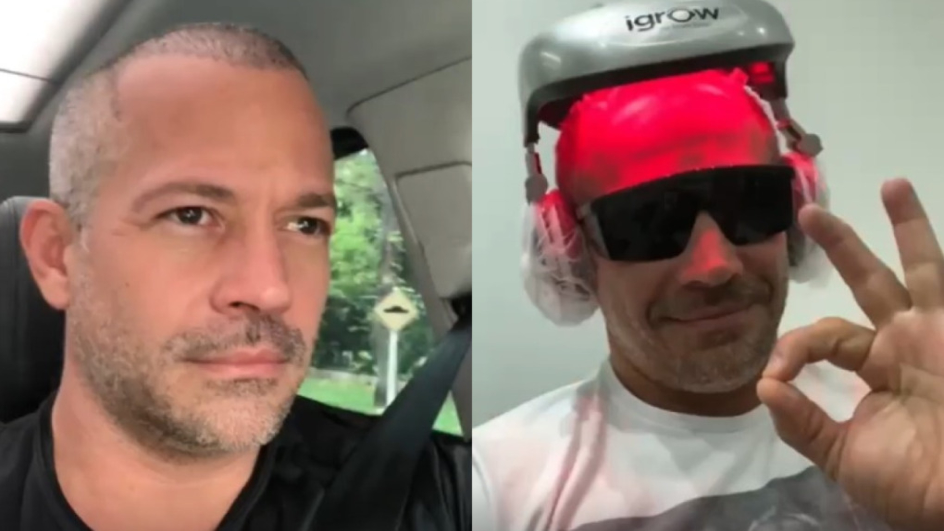 Satisfeito! Malvino Salvador mostra antes e depois do implante capilar: “Ainda mais lindo”