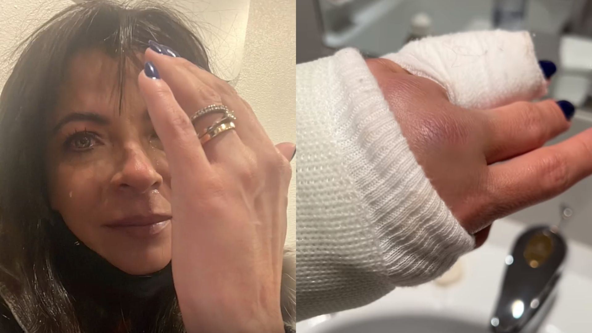 Anna Lima tem dedo quebrado por instrutor durante passeio de esqui: “Deu um soco”