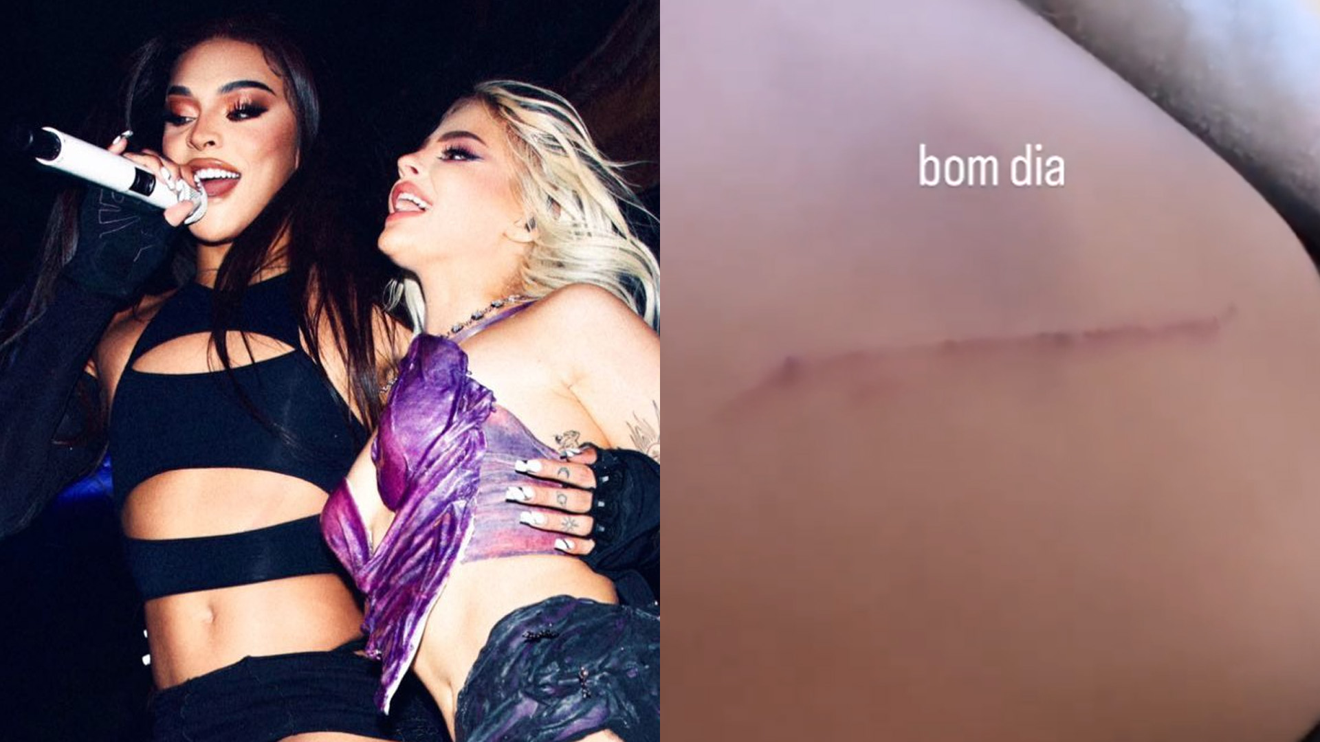 Pabllo Vittar aparece toda machucada após festa de Luísa Sonza: “Bom dia”