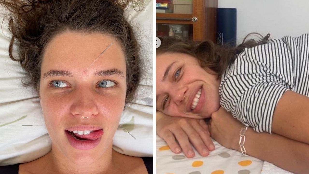 Bruna Linzmeyer mostra bumbum repleto de agulhas durante tratamento: “Me acompanham há 11 anos”