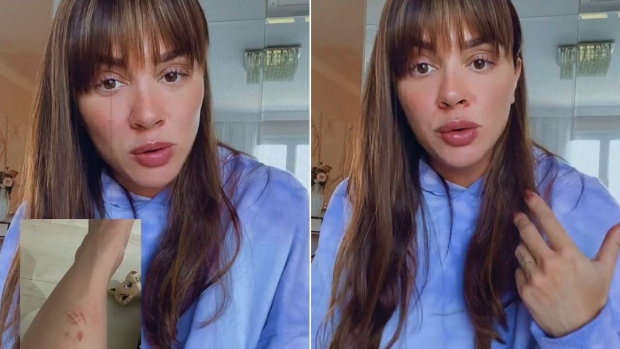 Juju Salimeni desabafa e conta aos fãs drama após manifestação de doença rara: “Me rasgava inteira”
