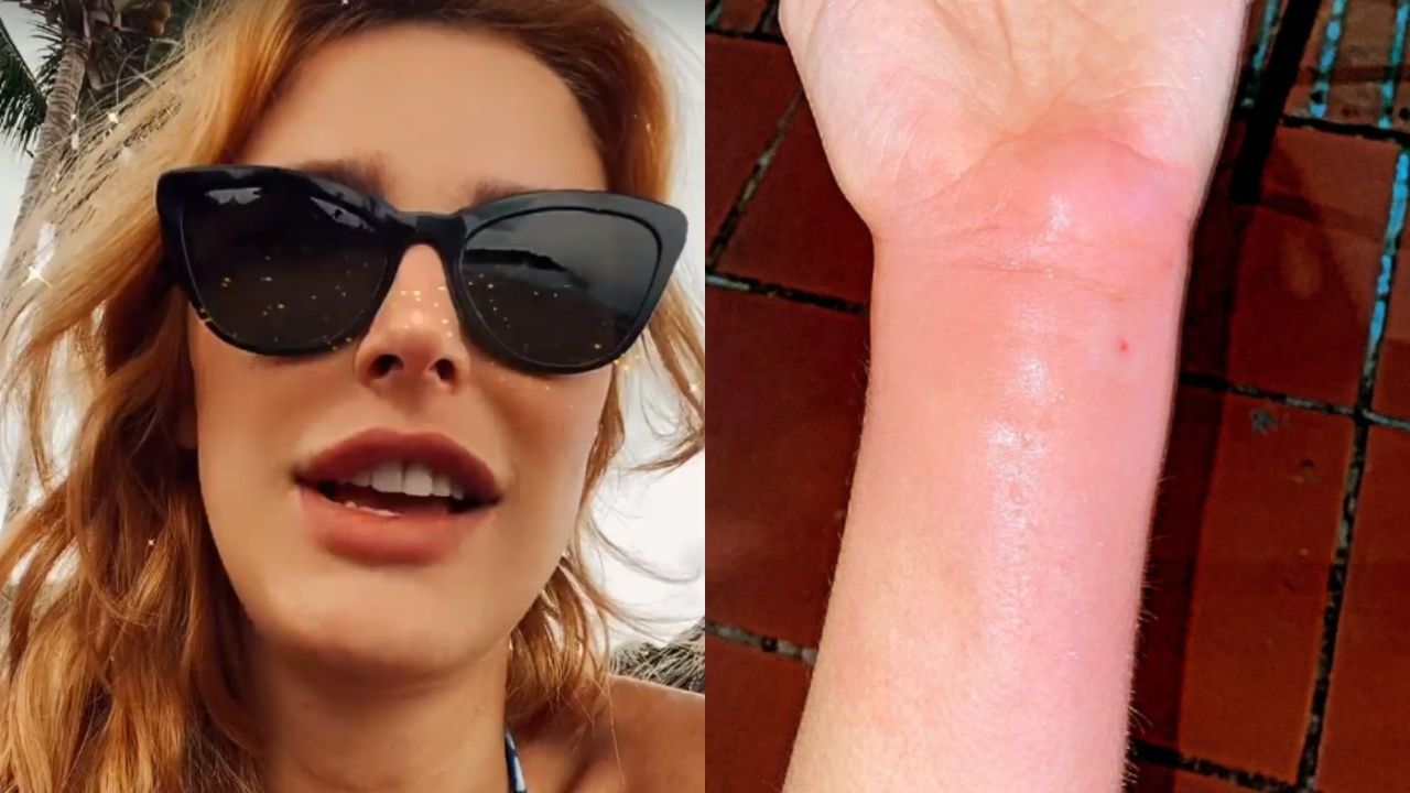 Eita! Após picada de inseto, Rafa Brites mostra pulso lesionado e relata: “Parecia que estavam enfiando uma agulha”