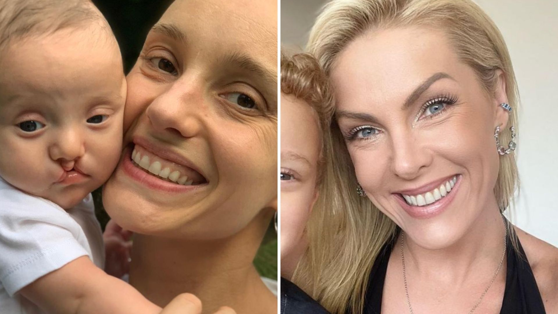 Ana Hickmann mostra antes e depois do sobrinho que nasceu com lábio leporino: “Lindo”