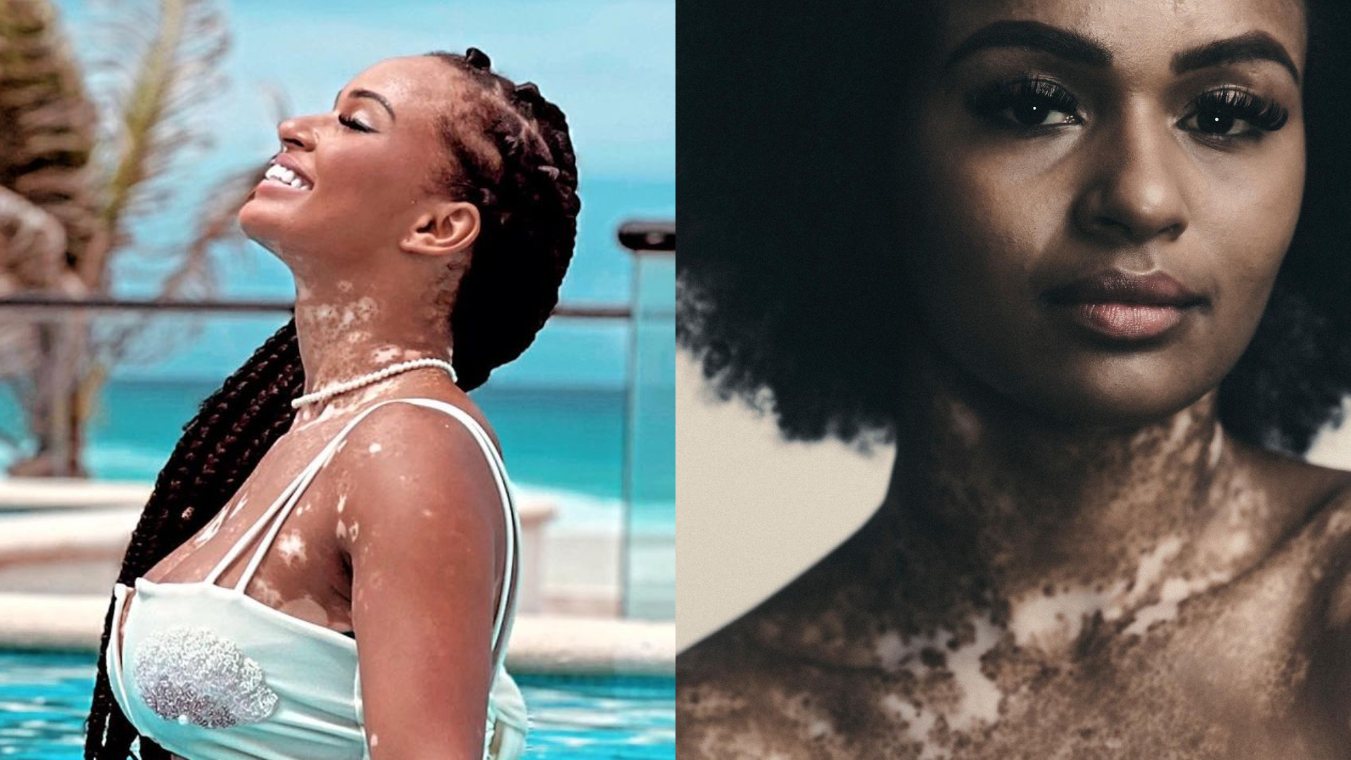 Ex-BBB Natália exibe corpão sem retoques e desabafa sobre vitiligo: “Me odiei”
