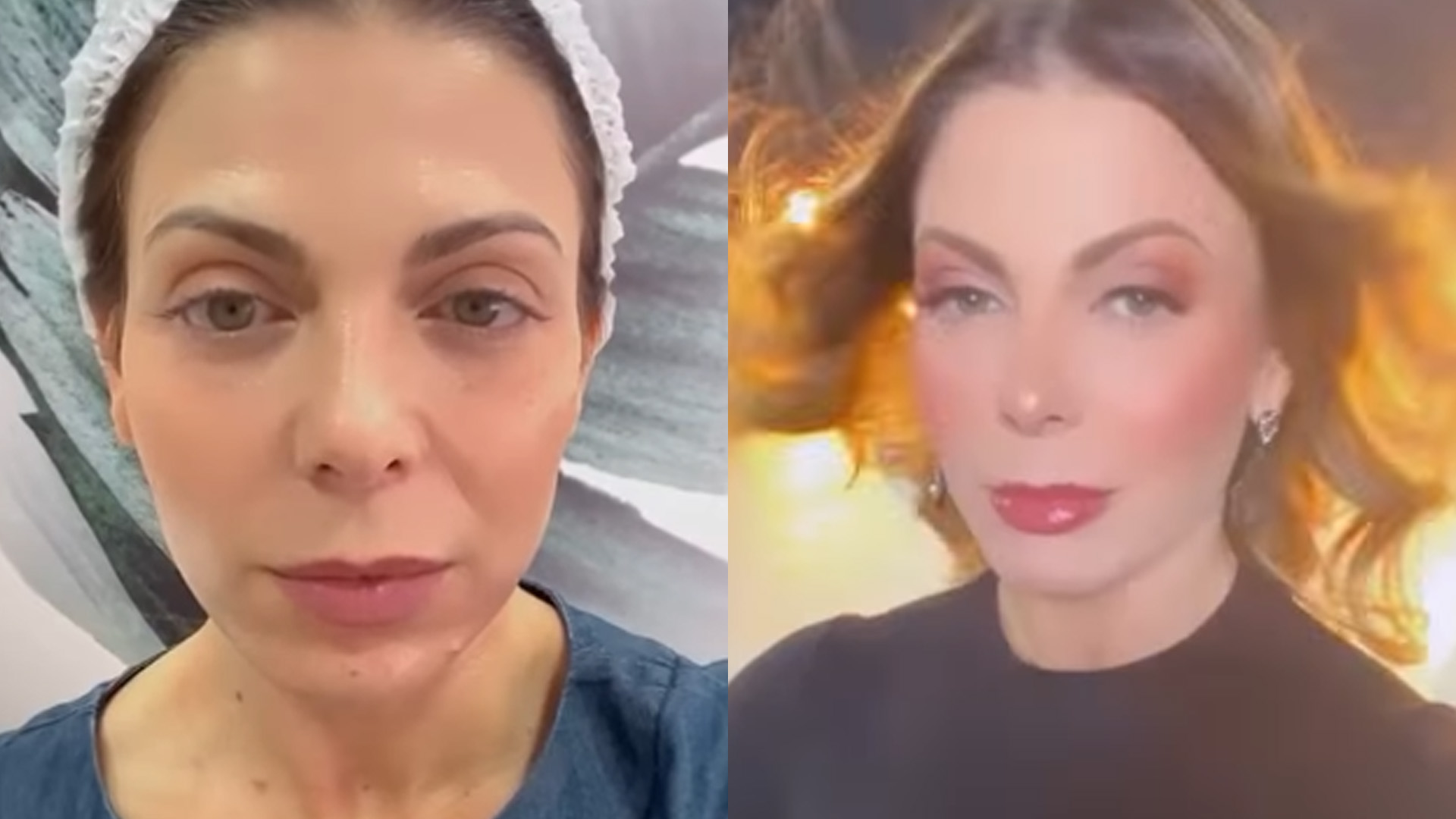 Sheila Mello mostra antes e depois de retoque do botox: “Muito mais gata”