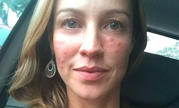 Picada de abelha? Luana Piovani mostra rosto inchado