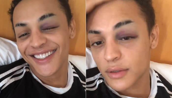 Pabllo Vittar aparece com o olho roxo e cancela gravação
