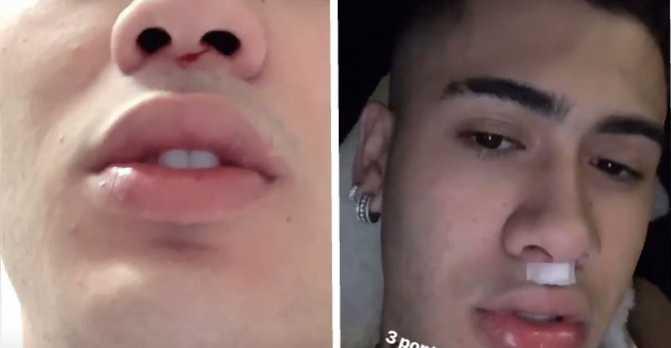 Kevinho interrompe show em São Paulo após acidente e vai parar no hospital: “Levei uns pontos”