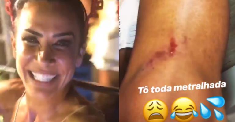 Após noite de folia, Scheila Carvalho mostra machucados: ”Olha a situação”
