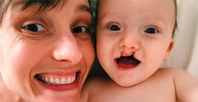 Isabel Hickmann desabafa sobre cirurgia do filho: ”Difícil aceitar a mudança do meu bebê”