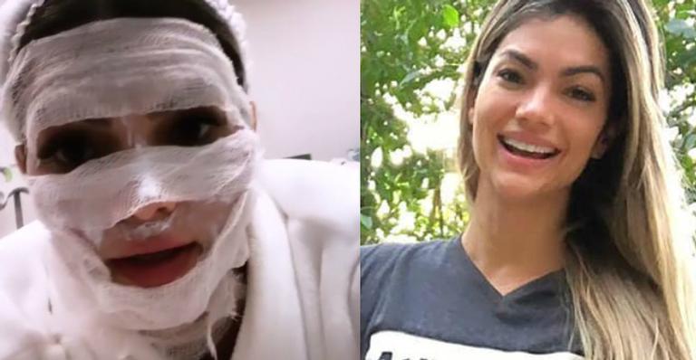 Kelly Key choca seguidores com antes e depois de procedimento: ”Cara cheia de sangue”