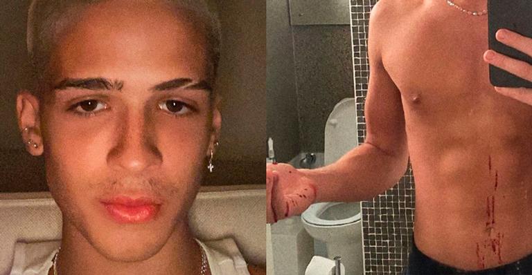 João Guilherme tem sangramento no nariz e assusta fãs: ”Meu Deus!”