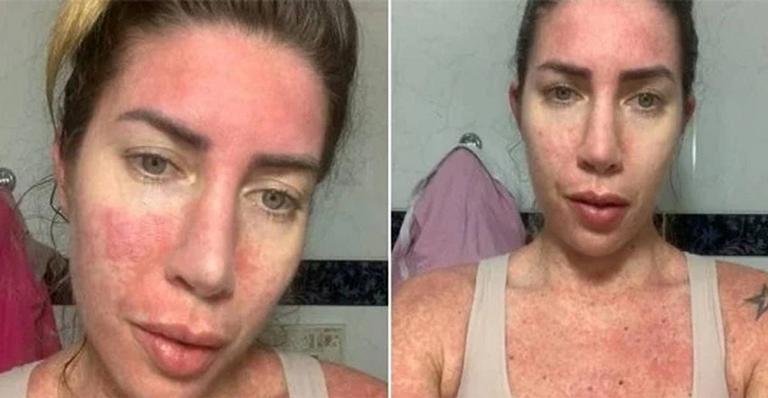 Após 35 dias internada, Tati Minerato diz que vida foi salva pelo SUS: “Não é normal”