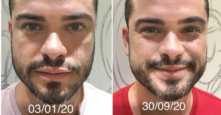 Sidney Sampaio surpreende ao mostrar resultados de transplante capilar: ”Lindo”