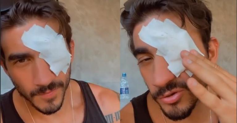 Ex-BBB Gui Napolitano é impedido de viajar após ferimento no olho: “Está bem feio”