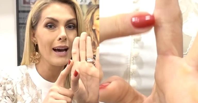 Ana Hickmann passa por cirurgia para remover cisto em dedo: ”Incomodava”