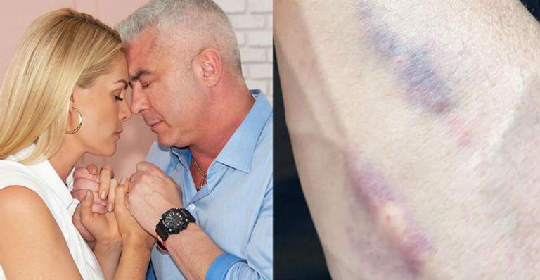 Em tratamento contra o câncer, marido de Ana Hickmann mostra roxos no antebraço