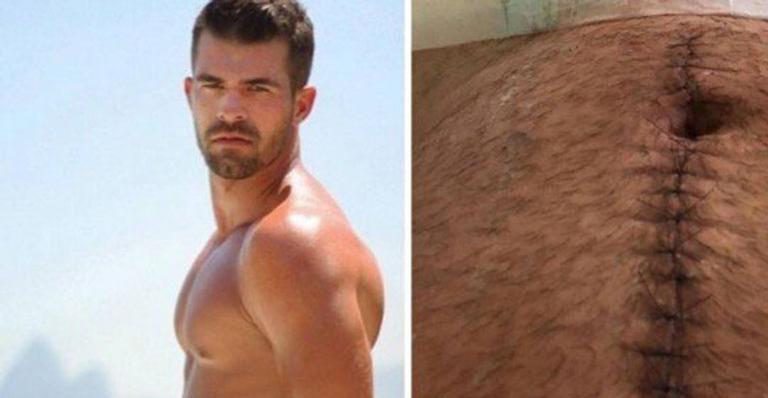 Borat do Amor & Sexo mostra cicatriz gigante no abdômen após ser baleado: “Renascimento”
