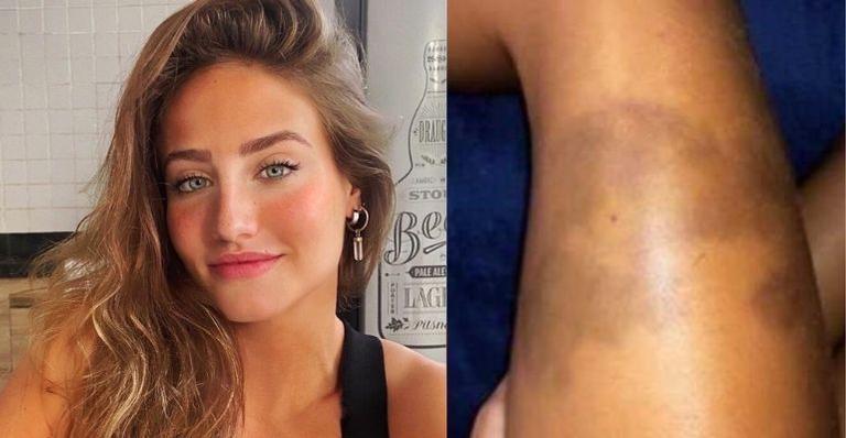Susto! Bruna Griphao surge com hematomas no corpo após ser atacada por animal: “Foi uma mordida”