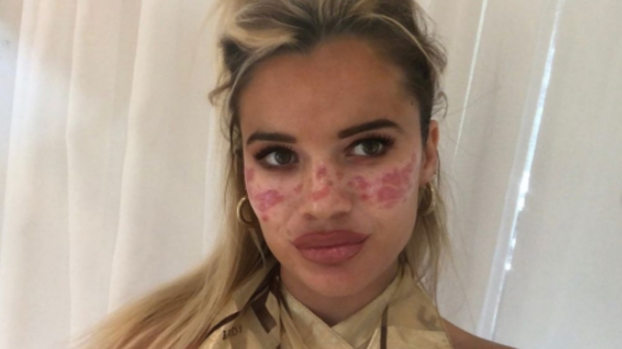 Eita! Ex-BBB australiana revela como ganhou cicatrizes após reproduzir truque de beleza duvidoso da internet