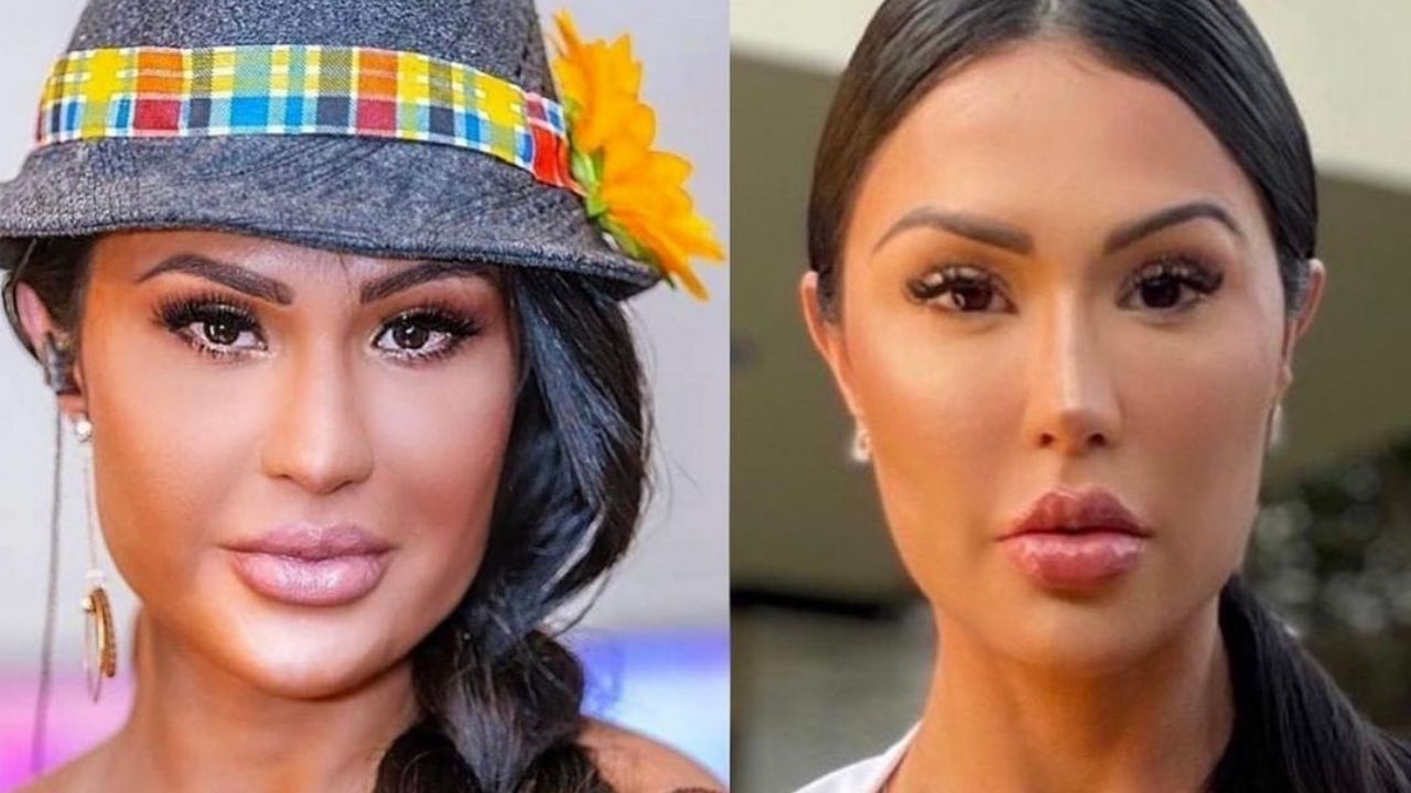 Gracyanne Barbosa mostra antes e depois ao afinar o rosto e explica procedimento: “Muita gente me perguntando”