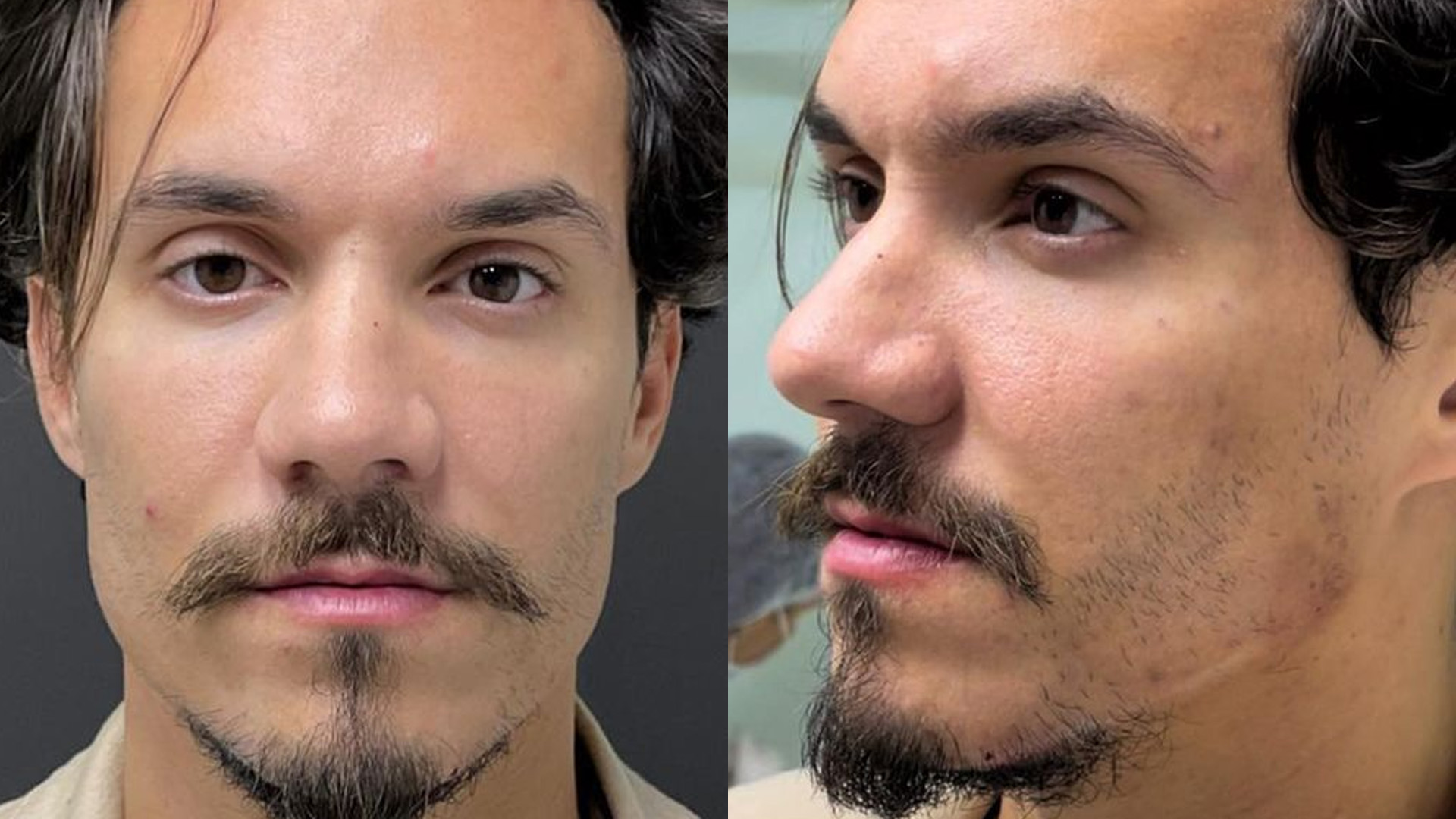 Ex-BBB Eliezer faz nova harmonização facial e aparece irreconhecível: “Amei”