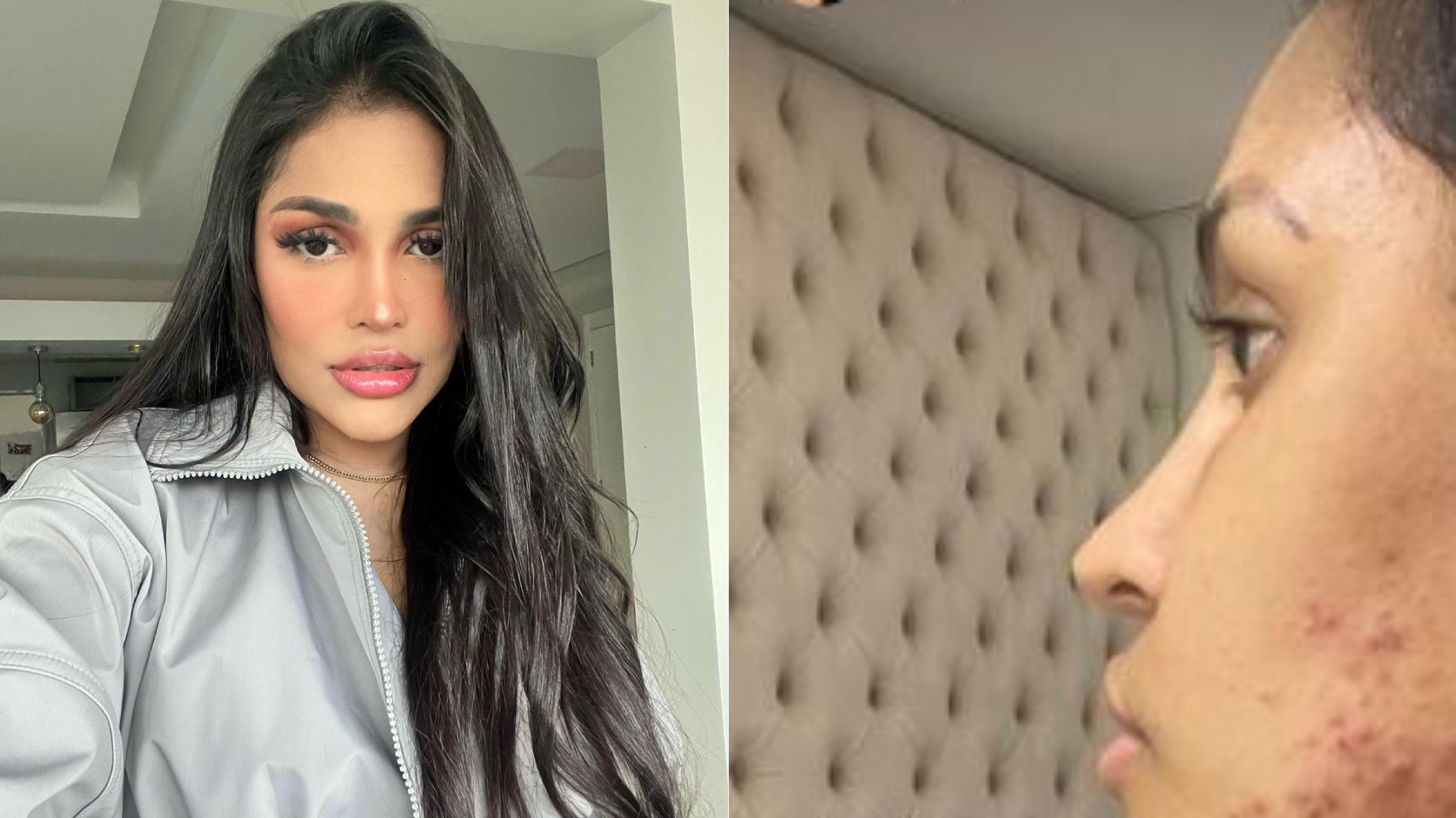 Ex-BBB Flay surge com o rosto irreconhecível e desabafa: “Destruiu minha pele”