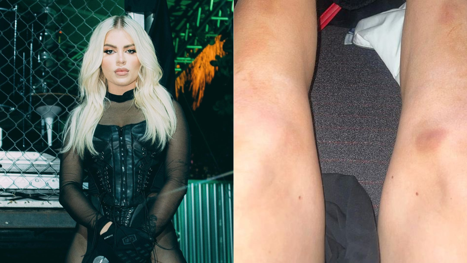 Luísa Sonza surge com pernas cheias de hematomas e assusta fãs: “Meus Deus”