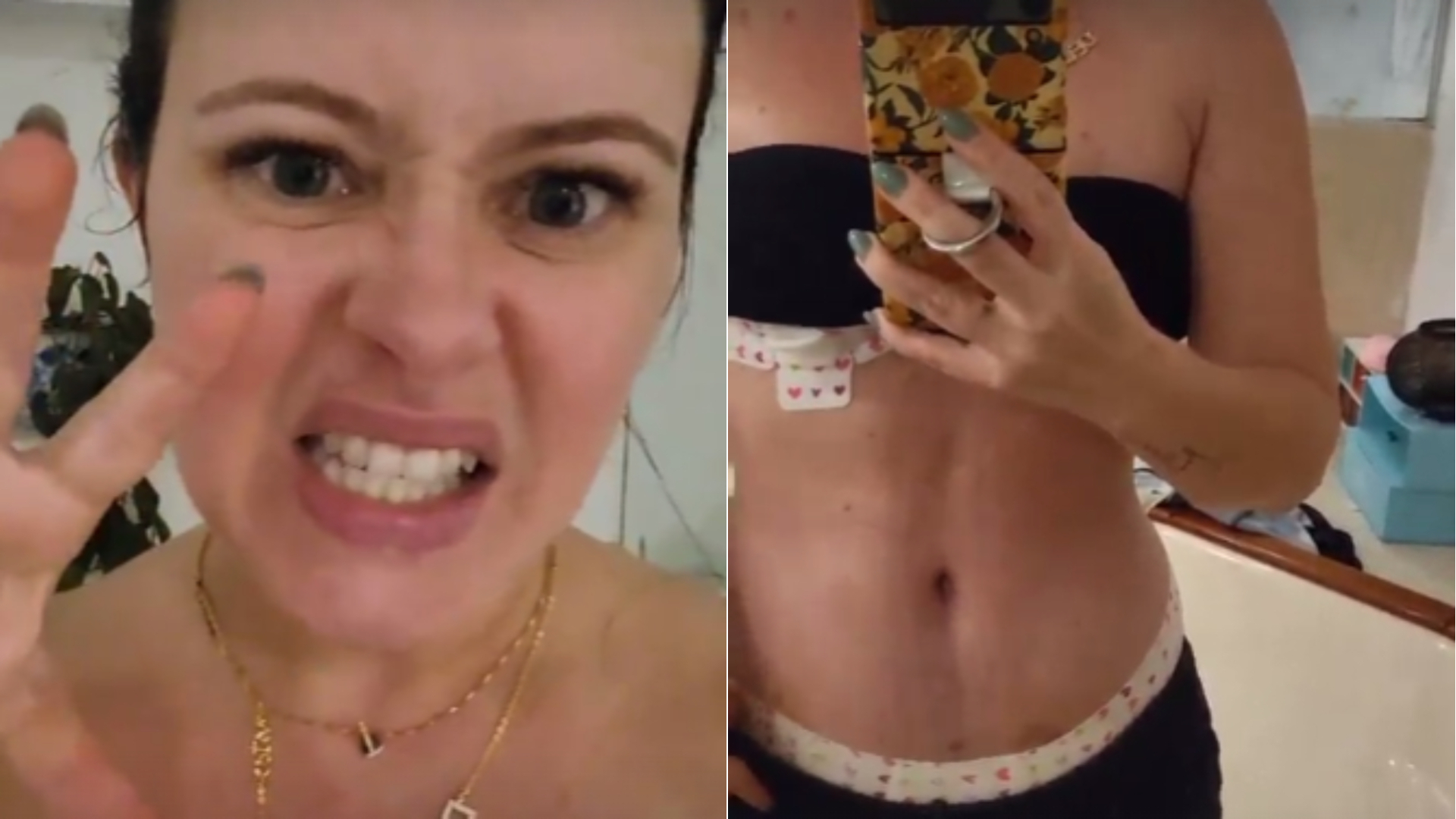 Mari Bridi surge sem cinta após cirurgia e exibe corpo cheio de hematomas: “Roxo”