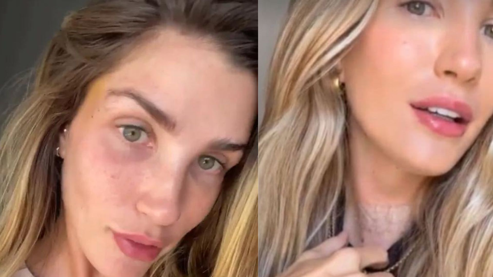 Ex-BBB Aline Gotschalg revela grave problema após câncer: “Doeu muito”