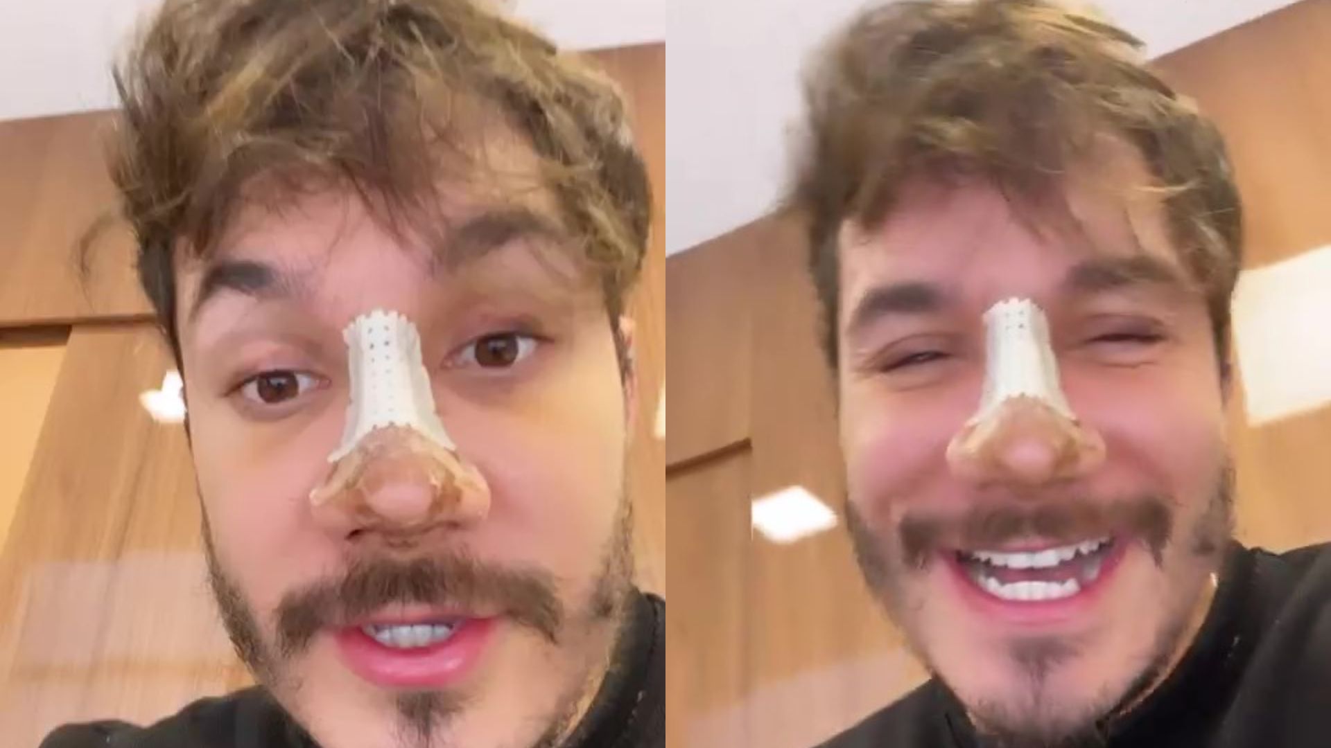 Ex-BBB Eliezer mostra resultado de rinoplastia sem curativos: “Bem natural”